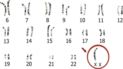 ແປກທີ່, ເດັກຍິງອາຍຸ 24 ປີຍັງບໍ່ຮອດໄວຫນຸ່ມຍ້ອນ "ຄວາມຜິດພາດແບບສຸ່ມ" ຂອງຮ່າງກາຍຂອງນາງ.