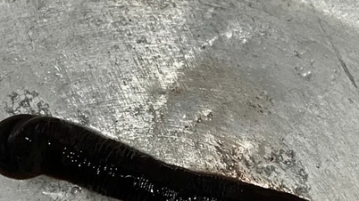 Gắp thành công con vắt dài 6cm trong mũi bệnh nhân