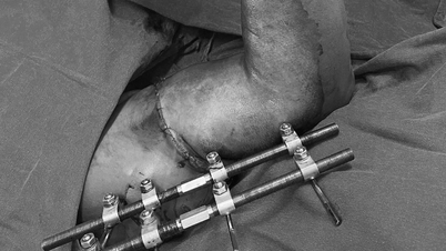 Pembedahan 5 jam untuk menyambung semula lengan lelaki yang terputus