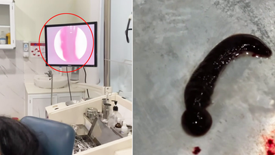 Yaşlı kadının burnunda 3 hafta boyunca yaşayan 6 cm'lik korkunç sülük