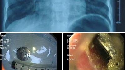 Un băiat din Hai Phong a suferit un ulcer esofagian sever după ce a înghițit o baterie tip buton.