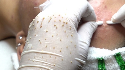 ألم غير متوقع بعد الإصابة بفيروس نقص المناعة البشرية من علاج سبا