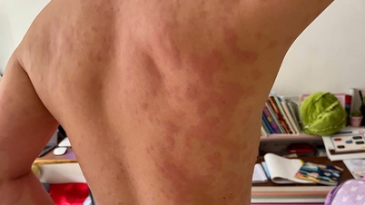Doctor 24/7: Urticarie care provoacă mâncărime, este nevoie de teste pentru a afla cauza?
