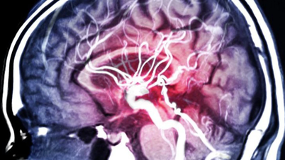 Šokující objev: Krevní tlak se sice nezvýšil, ale mozek zestárl