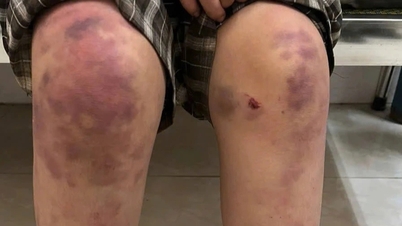 Menina de 12 anos suspeita de ter sido abusada pela avó, felizmente sem fraturas.