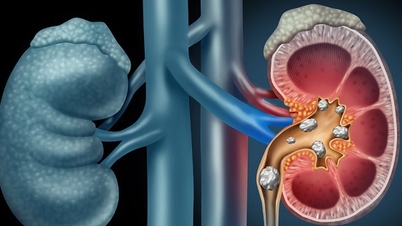 វិធី​ព្យាបាល​គ្រួស​ក្នុង​តម្រងនោម​ឱ្យ​បាន​ត្រឹមត្រូវ​អ្នក​ត្រូវ​ដឹង