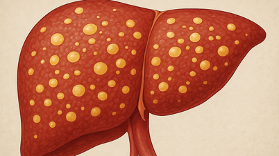 Az orvosok figyelmeztetnek: Gyakori hibák, amelyek zsírmáj kialakulásához vezethetnek a vékony embereknél