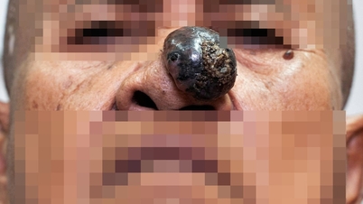 Old lady with necrotic nasal tip tumor, continuous bleeding