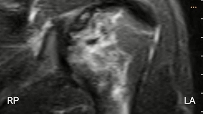 Un buceador con más de 20 años de experiencia sufrió necrosis en los huesos del brazo y del muslo.