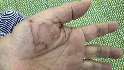 Where to go for examination and treatment for parasitic infection?