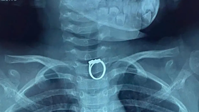 内視鏡検査で5歳女児の食道からリングを除去