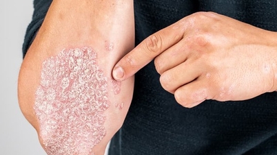 ជំងឺស្បែករបកក្រហម៖ តើមានសញ្ញាអ្វីខ្លះ ហើយនរណាជាអ្នកប្រឈមមុខ?