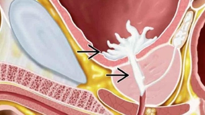 Das Ausbleiben von Samenflüssigkeit nach dem Geschlechtsverkehr ist ein Warnzeichen für eine retrograde Ejakulation.