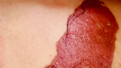 បំណះ​ព្យាបាល​ដុំ​សាច់​ក្នុង​សុដន់​បណ្តាល​ឱ្យ​មាន​ពងបែក​លើ​ស្បែក ការ​ពិនិត្យ​ឃើញ​ថា​កើត​មហារីក