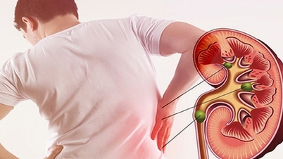 Đau lưng âm ỉ một năm, người đàn ông 54 tuổi phát hiện thận bị phá hủy bởi sỏi san hô khổng lồ