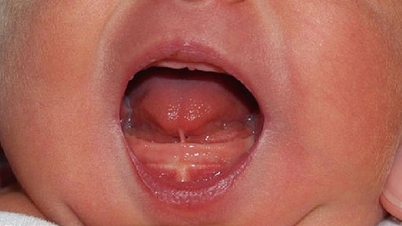 សញ្ញាដំបូងនៃការចងអណ្តាតចំពោះកុមារ និងពេលណាត្រូវអន្តរាគមន៍