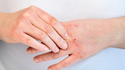 טעויות נפוצות הגורמות לקילוף וסדיקת עור בעת שימוש בתנורי חימום במזג אוויר קר