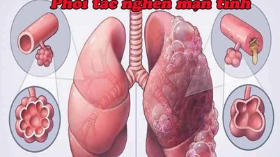 Mengenali Penyakit Pulmonari Obstruktif Kronik