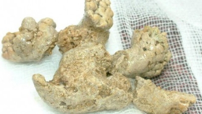 ما هي حصوات المرجان في الكلى وهل هي خطيرة؟