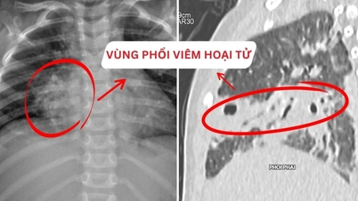 2-jarig meisje met necrotiserende longontsteking na 6 dagen hoesten en koorts