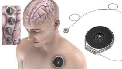 Le concurrent de Neuralink teste des implants de puces dans le cerveau humain.
