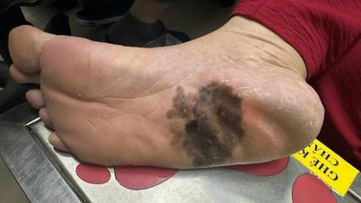 Bacaklardaki siyah noktalardan cilt kanserinin erken teşhisi