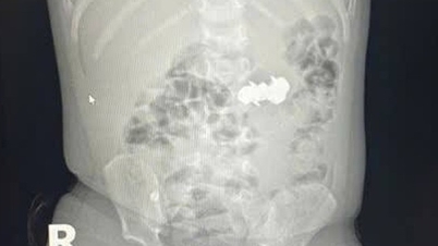 Мальчик проглотил 4 опасных острых магнитных гвоздя