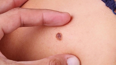 Mange går til legen og oppdager hudkreft fra svarte flekker på føttene.