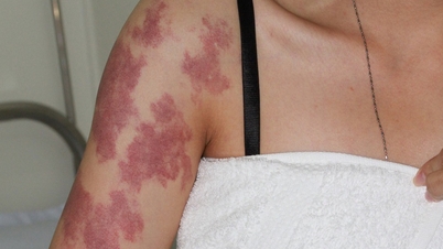 क्या पोर्ट वाइन के दागों का उपचार किया जाना चाहिए?