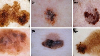 Dark spots on the skin, when is it a sign of skin cancer?
