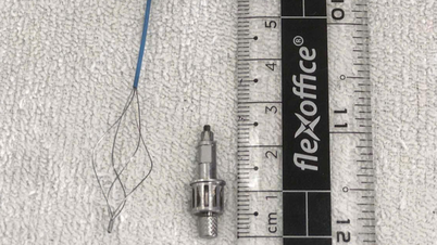 Un homme souffre d'une toux persistante après une intervention dentaire ; il découvre des instruments dentaires dans une bronche.