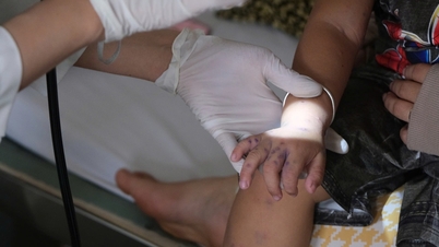 V mnoha provinciích na Západě rychle narůstá výskyt onemocnění rukou, nohou a úst.