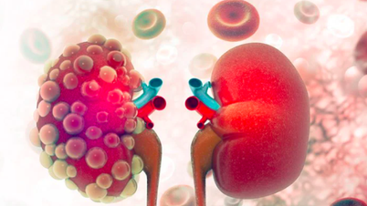 Uzun süredir sırt ağrısı çeken 60 yaşındaki adamda nadir görülen böbrek kanseri tespit edildi