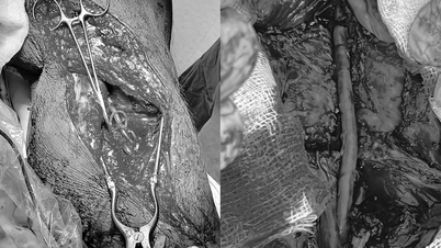 Male patient hospitalized because of purple legs, cold numbness, poor mobility