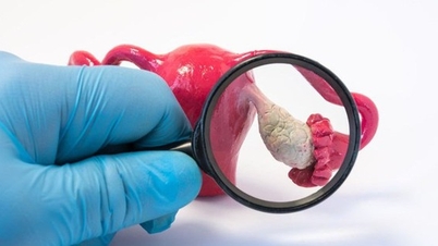 Загальні ознаки синдрому полікістозних яєчників