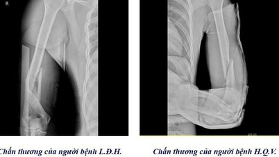 Warning of the risk of broken arm bones from arm wrestling