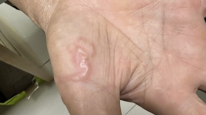 Objawy zarażenia robakami należy zbadać wcześnie. Gdzie udać się na badanie?