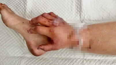 ស្ត្រី​មាន​ផ្ទៃពោះ​ដែល​កាត់​ដៃ​ជា​បណ្ដោះ​អាសន្ន​ត្រូវ​បាន​វះកាត់​«​វាសនា​»