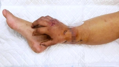 गर्भवती महिला के लिए 65 दिनों का चमत्कार, जिसे अस्थायी रूप से कटे हुए हाथ को पैर पर प्रत्यारोपित करना पड़ा