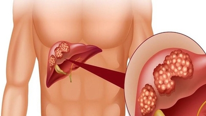Beware of esophageal varices