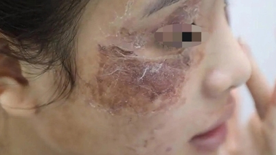 Mädchen gerät in Schwierigkeiten, weil sie eine online gekaufte Creme im Wert von 600.000 VND verwendet.