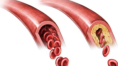 बायोरिएक्टर प्रणालियों का उपयोग करके छोटे व्यास वाले संवहनी ग्राफ्ट का निर्माण