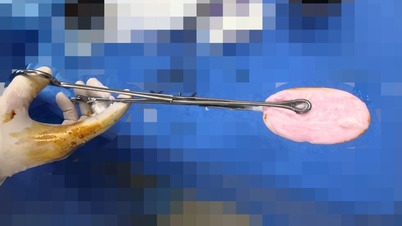 TPHCM: Cấp cứu bé gái 12 tuổi nhét cục xà bông vào vùng kín khi đang tắm