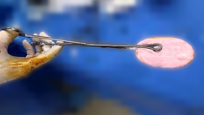 វេជ្ជបណ្ឌិត​ព្រមាន​ពី​និន្នាការ​កើនឡើង​គួរ​ឱ្យ​បារម្ភ​ក្នុង​ចំណោម​ក្មេង​ស្រី​អាយុ​ពី ១០-១៦ ឆ្នាំ។