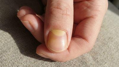 ការឌិកូដរាងអឌ្ឍចន្ទនៅលើក្រចក