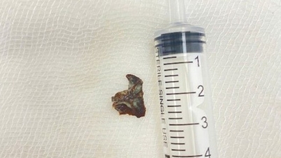 कई महीनों तक खांसने के बाद, अचानक वृद्ध व्यक्ति को पता चला कि उसके श्वास मार्ग में कोई बाहरी वस्तु फंस गई है।