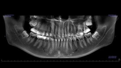 지혜니 발치 후 실수를 피하기 위한 의사의 가이드 - 많은 문제를 일으키는 '늦은 손님'
