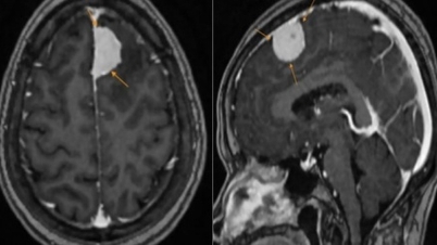 Meningiom, onemocnění, které postupuje tiše, ale je nebezpečné