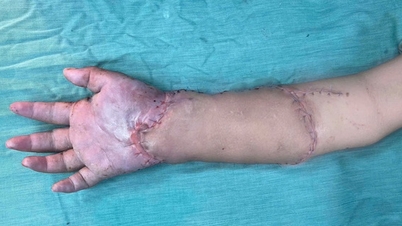 Doctorul Vo Thai Trung de la Spitalul General Binh Duong povestește despre transplantul temporar rar de la mână la picior, care a salvat mama și cei doi fetuși.