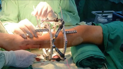 7 सेमी की दूरी वाले दो पैरों वाले किशोर के लिए पैर लंबा करने की सर्जरी